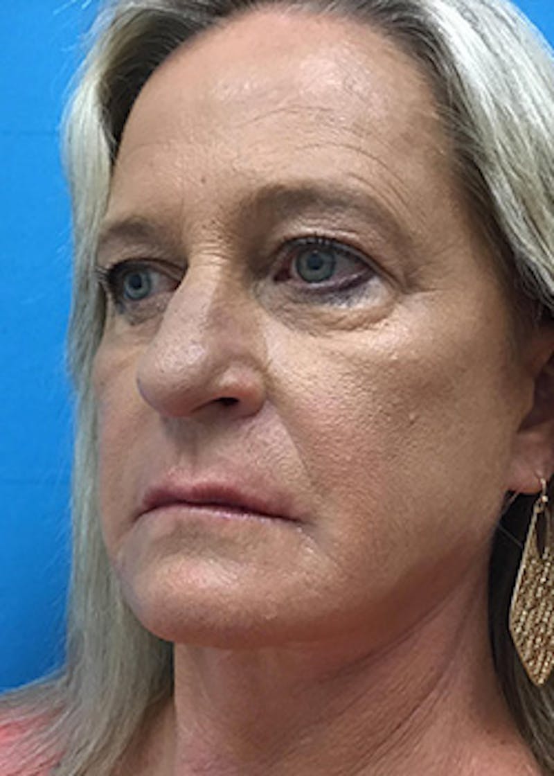 Fillers Before & After Gallery - Patient 148410555 - Image 8