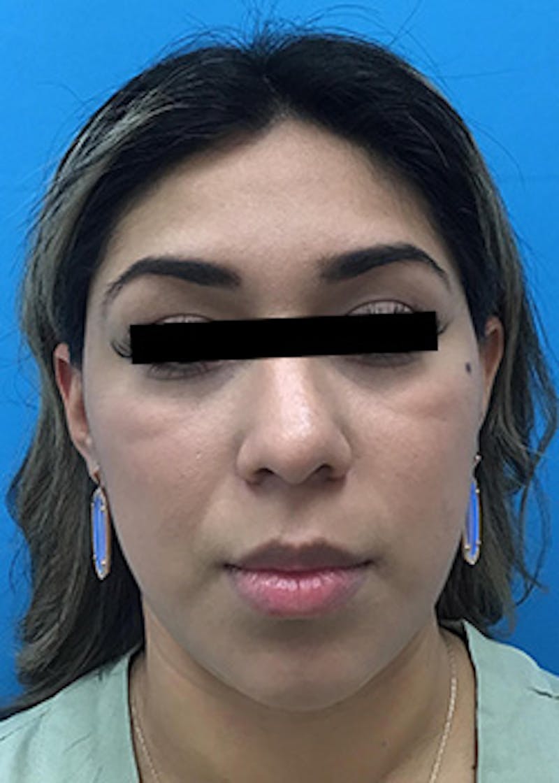 Fillers Before & After Gallery - Patient 148410556 - Image 1