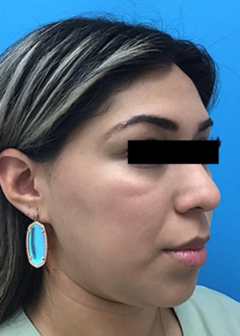 Fillers Before & After Gallery - Patient 148410556 - Image 3