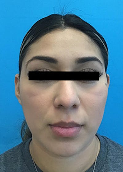 Fillers Before & After Gallery - Patient 148410556 - Image 2
