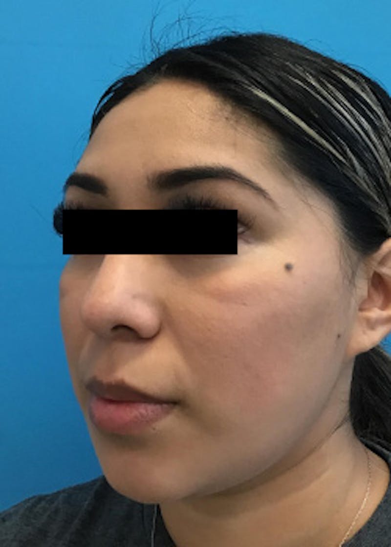 Fillers Before & After Gallery - Patient 148410556 - Image 6