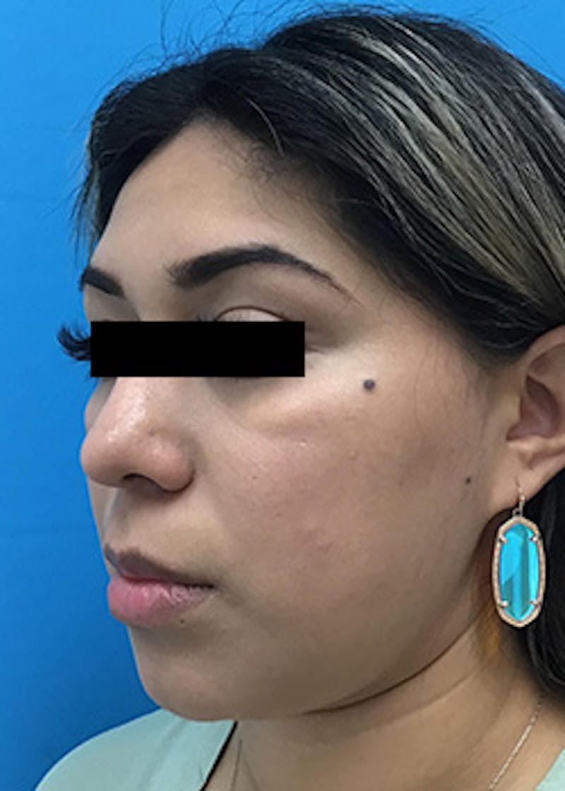 Fillers Before & After Gallery - Patient 148410556 - Image 5
