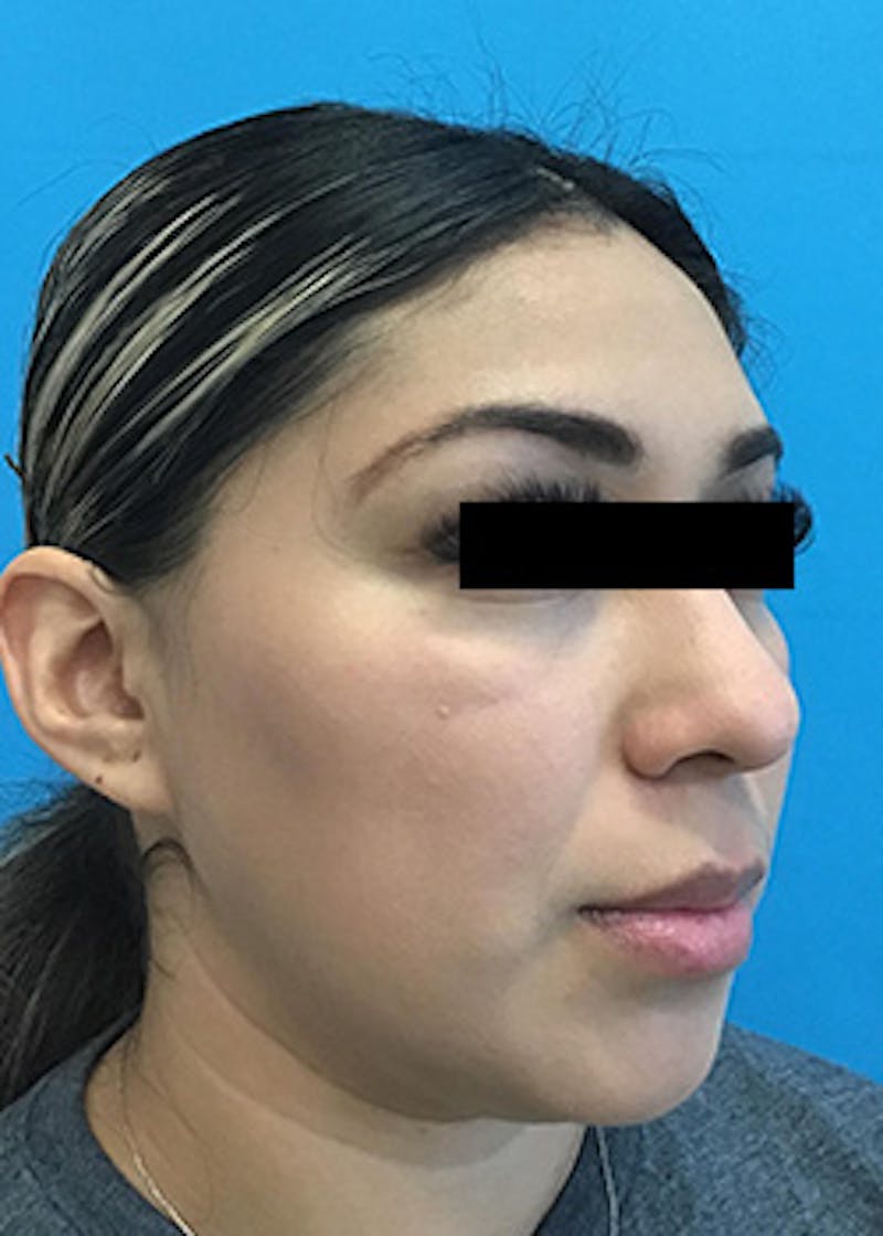 Fillers Before & After Gallery - Patient 148410556 - Image 4