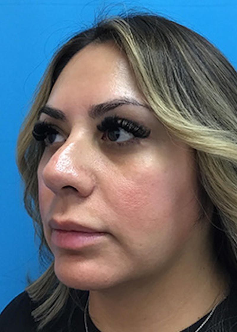Fillers Before & After Gallery - Patient 148410554 - Image 7