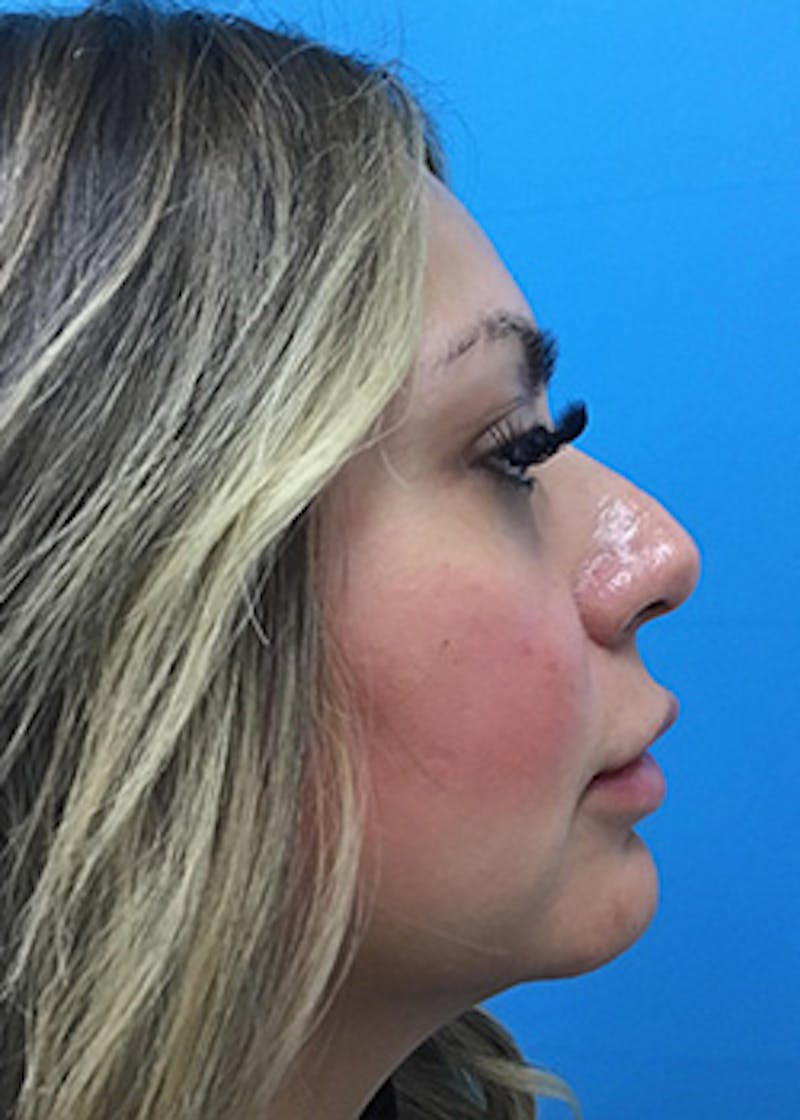 Fillers Before & After Gallery - Patient 148410554 - Image 6