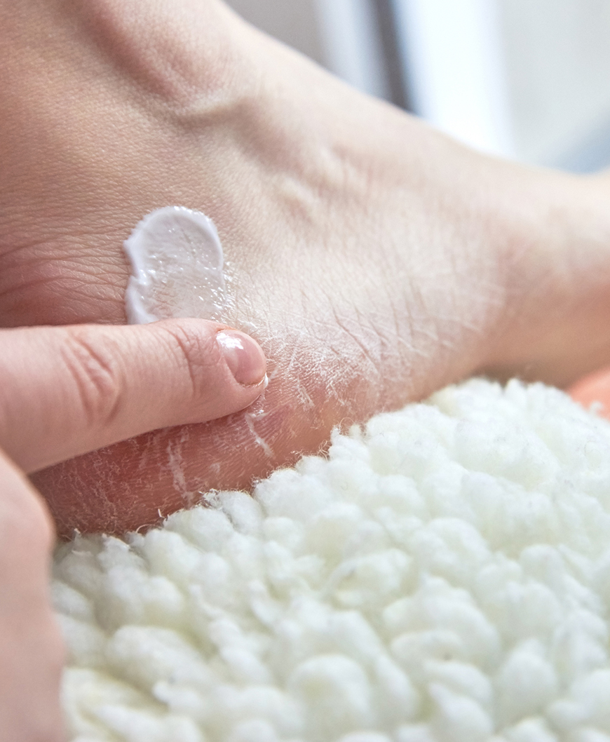 Cracked skin on hands and feet: Causes and treatments
