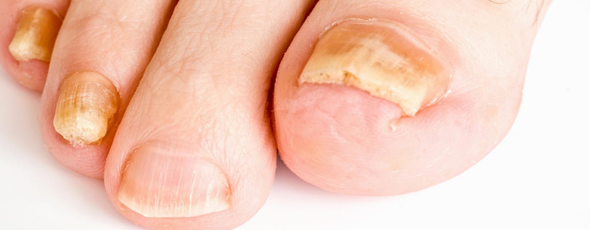 a close up of toes experiencing some fungal issues