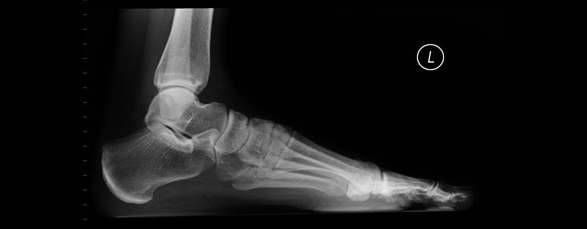 an xray of a foot and ankle