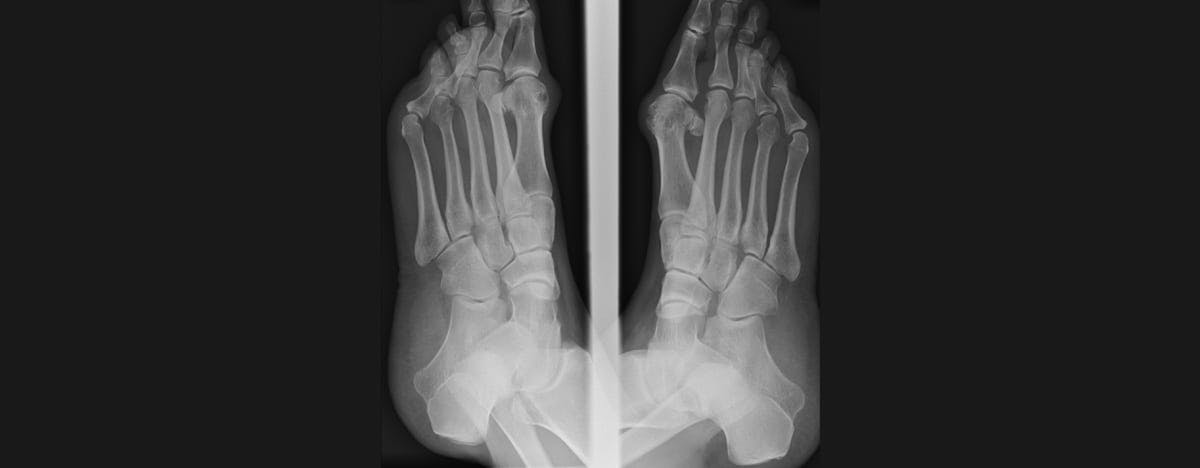 a xray of the left and right foot
