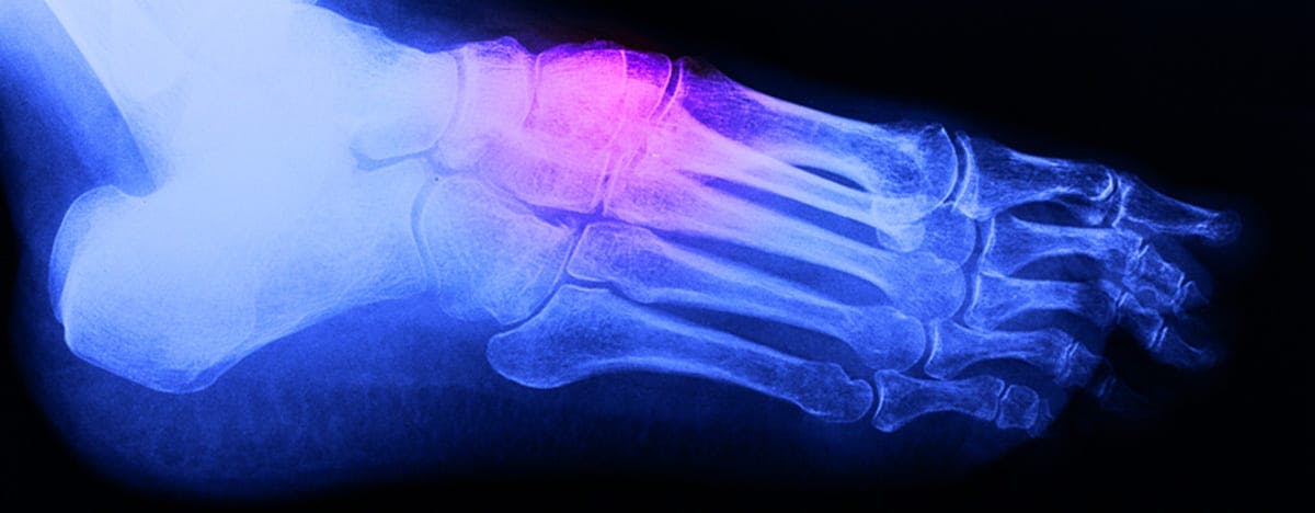 an xray of a foot with a pink spot highlighted on the top of the foot