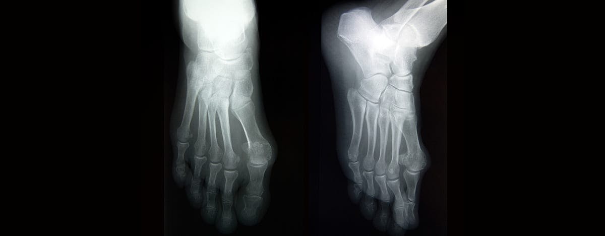 an xray of feet from the top and side view