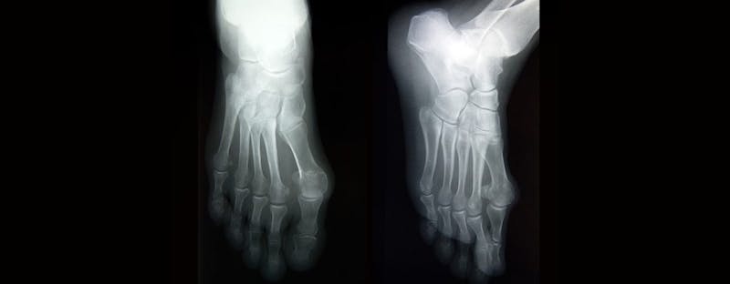 an xray of feet from the top and side view