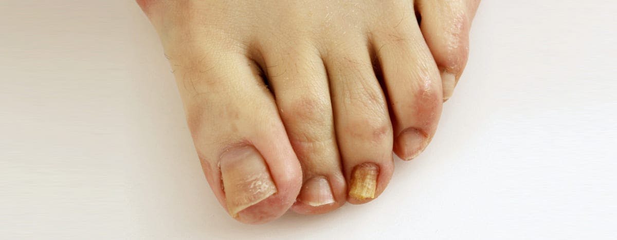 a close up of toes with a yellowish tint on the toenails