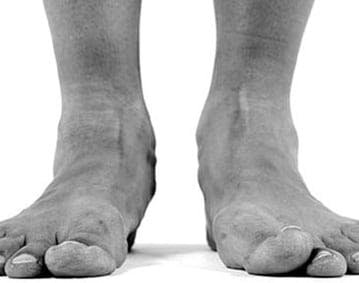 Flat Foot Correction And Reconstruction In Orange County