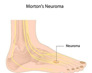 Neuroma Surgery In Orange County