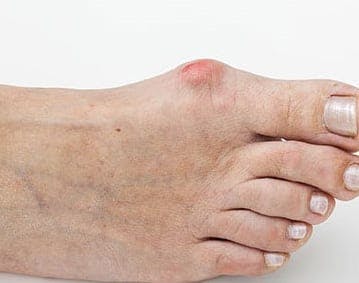 Orthotics For Bunions