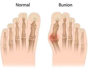 Surgical Treatment For Bunions