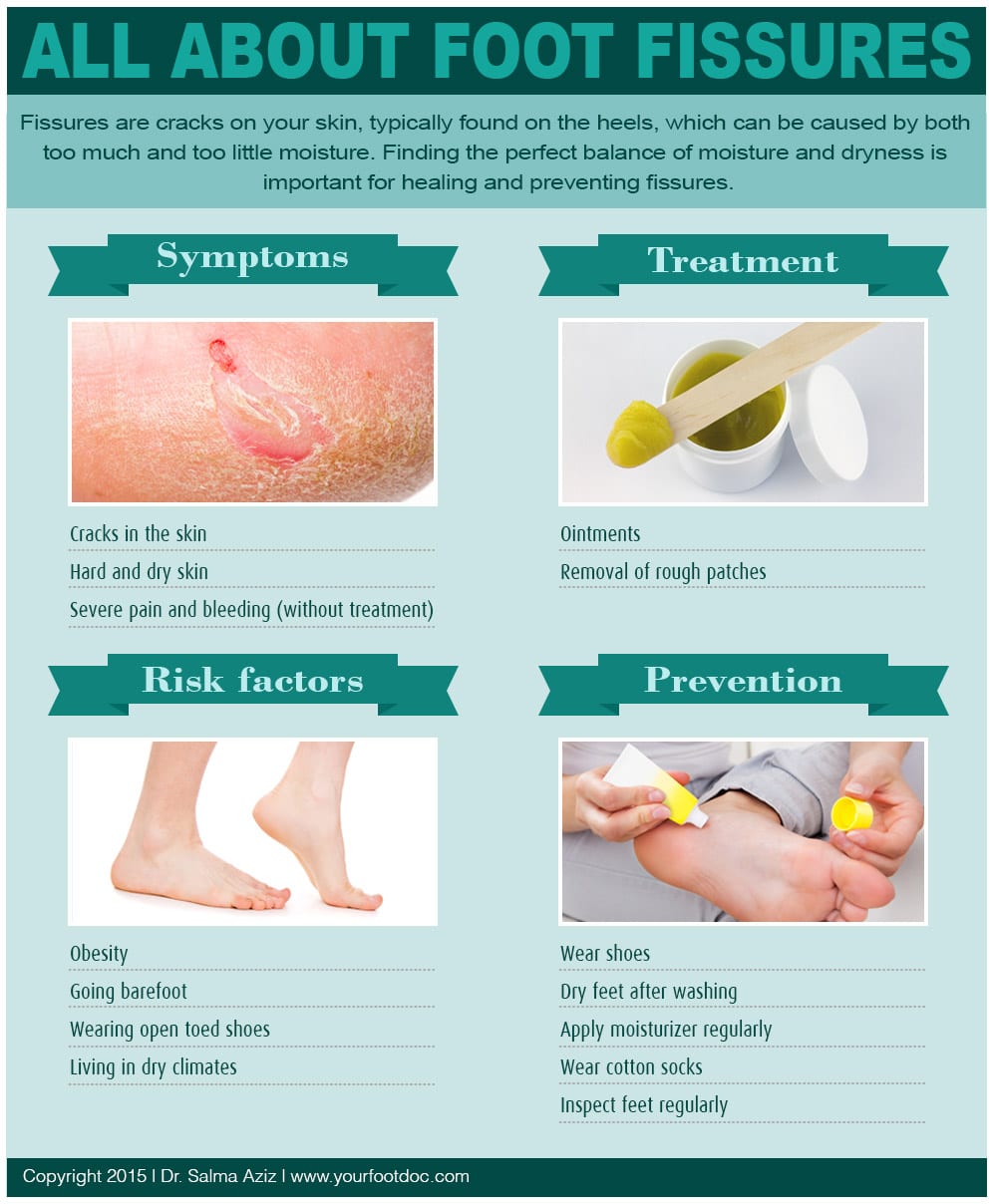 Foot Fissures Infographic