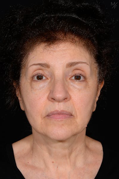 Facelift Before & After Gallery - Patient 141471965 - Image 1