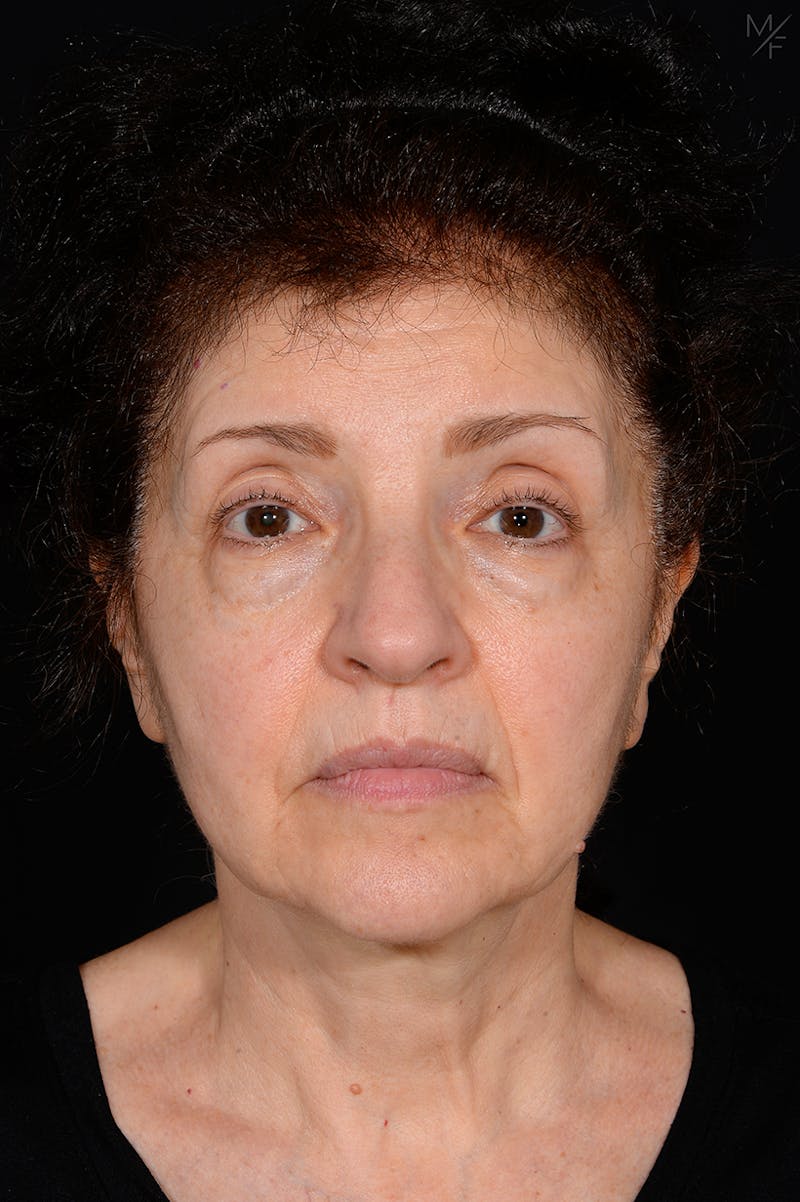 Facelift Before & After Gallery - Patient 141471965 - Image 1