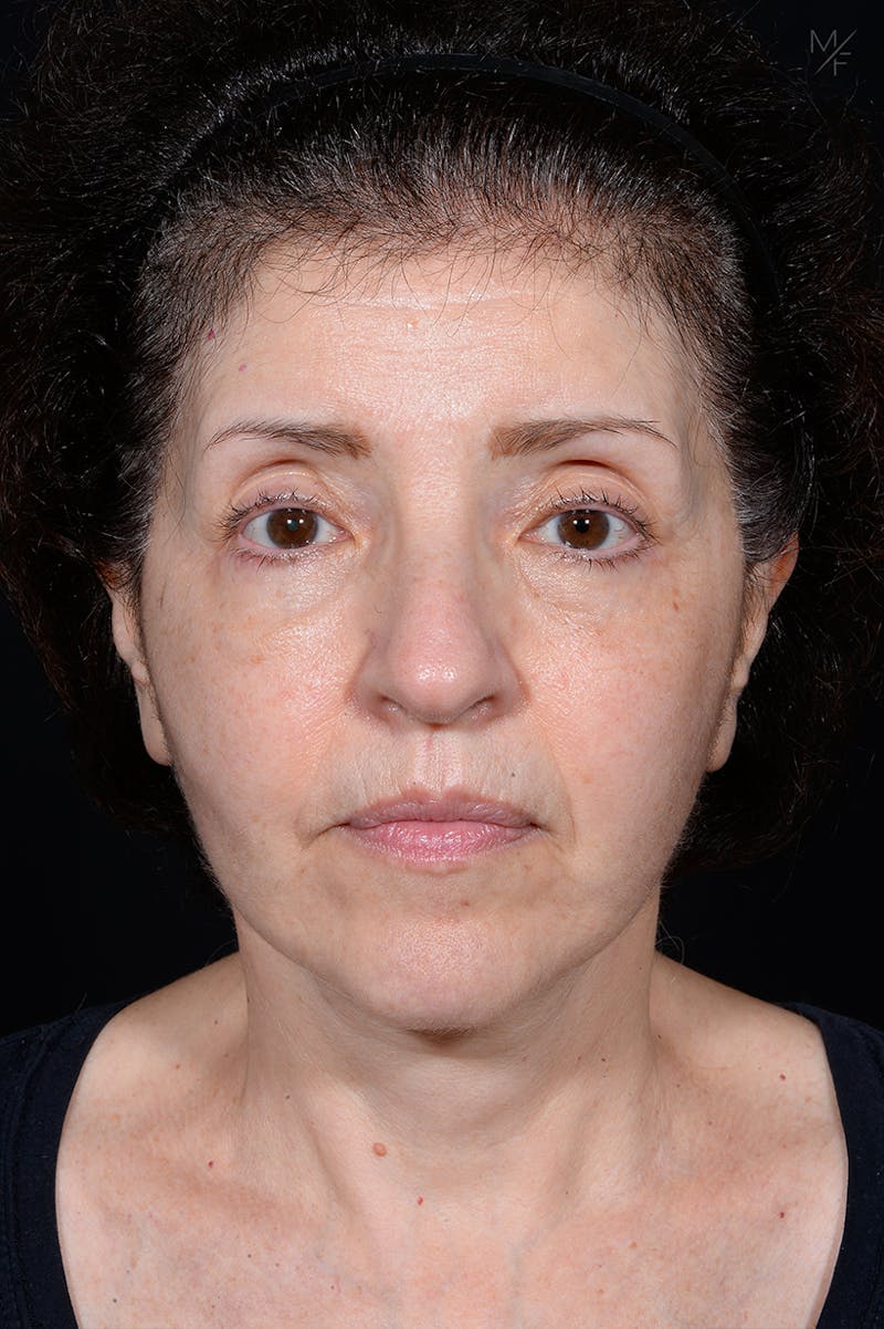 Facelift Before & After Gallery - Patient 141471965 - Image 2