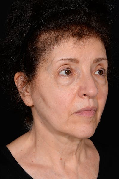 Facelift Before & After Gallery - Patient 141471965 - Image 1