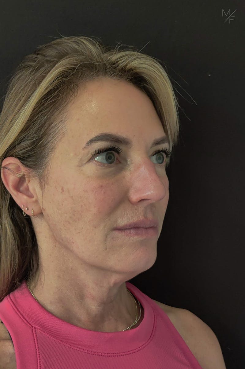 Facelift Before & After Gallery - Patient 121139445 - Image 3