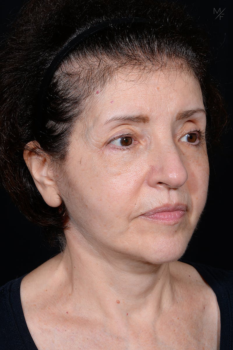 Neck Lift Before & After Gallery - Patient 646190 - Image 4