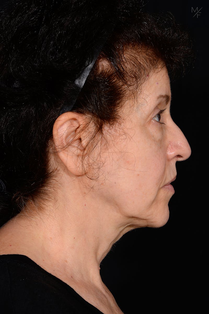 Facelift Before & After Gallery - Patient 141471965 - Image 5