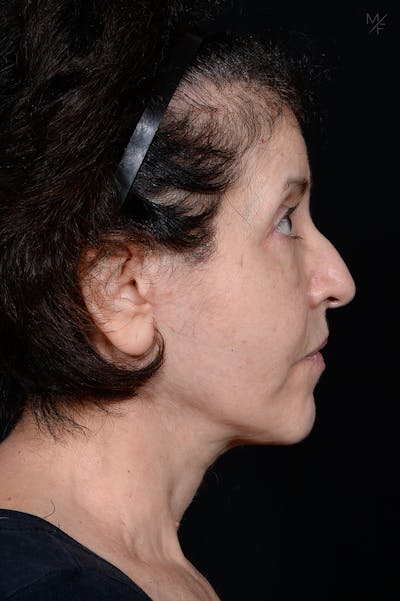 Neck Lift Before & After Gallery - Patient 646190 - Image 2