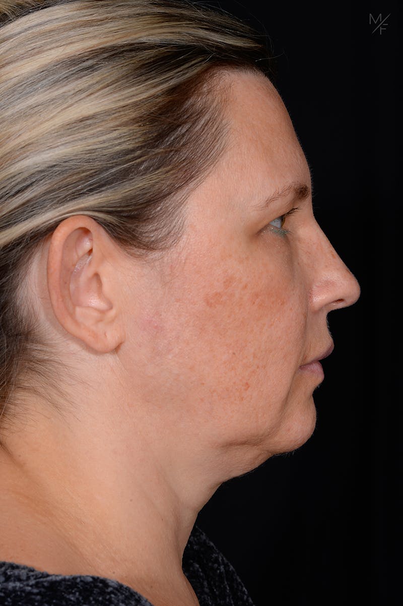 Rhinoplasty Before & After Gallery - Patient 121139454 - Image 1