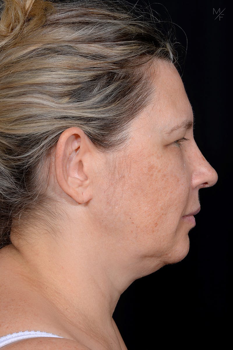 Rhinoplasty Before & After Gallery - Patient 121139454 - Image 2