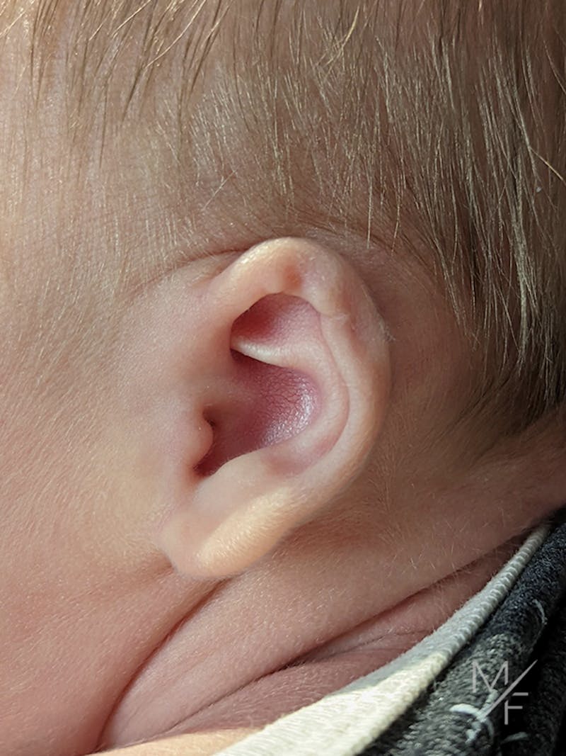 Ear Molding Before & After Gallery - Patient 121139466 - Image 1