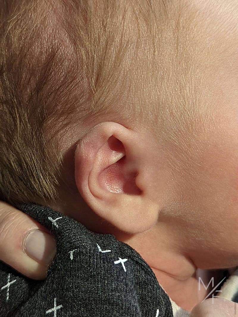 Ear Molding Before & After Gallery - Patient 121139466 - Image 3