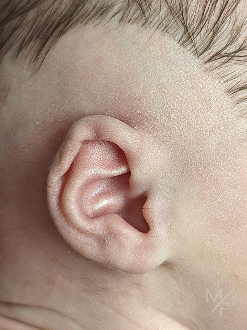 Ear Molding Before & After Gallery - Patient 121139467 - Image 1