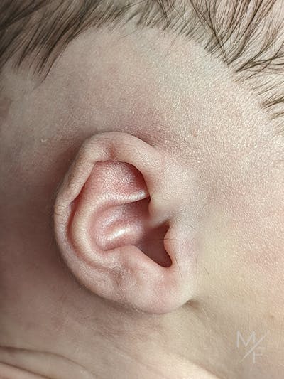 Ear Molding Before & After Gallery - Patient 121139467 - Image 1