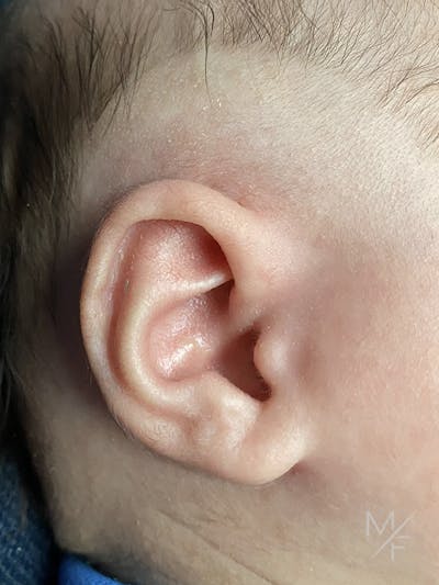 Ear Molding Before & After Gallery - Patient 121139467 - Image 2