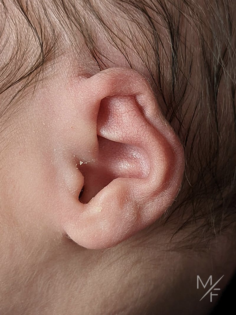Ear Molding Before & After Gallery - Patient 121139467 - Image 3