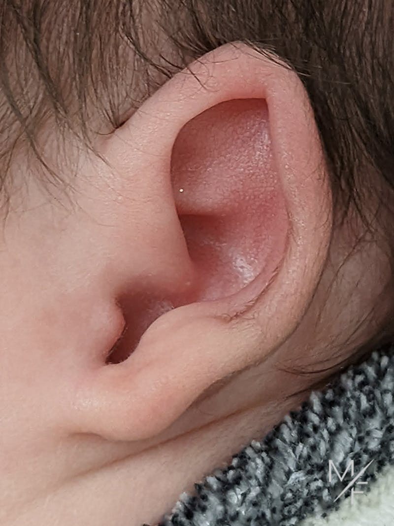 Ear Molding Before & After Gallery - Patient 121139468 - Image 1