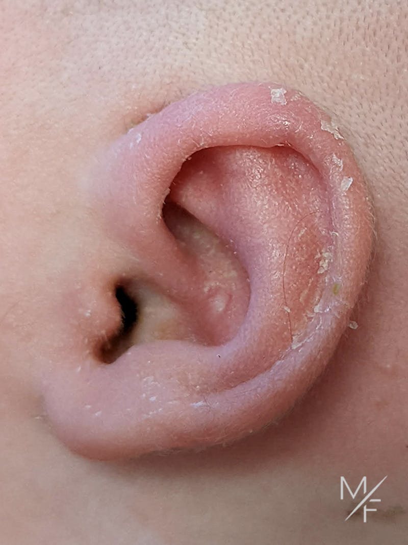 Ear Molding Before & After Gallery - Patient 121139468 - Image 2