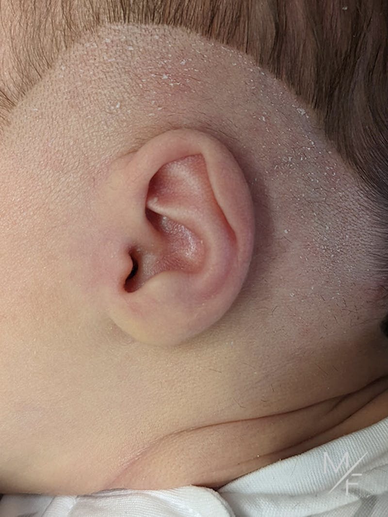 Ear Molding Before & After Gallery - Patient 121139469 - Image 1