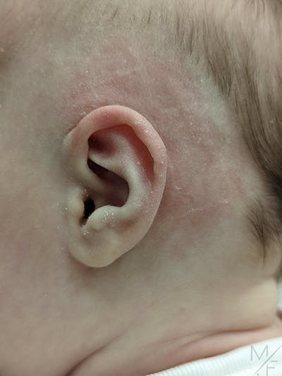 Ear Molding Before & After Gallery - Patient 121139469 - Image 2