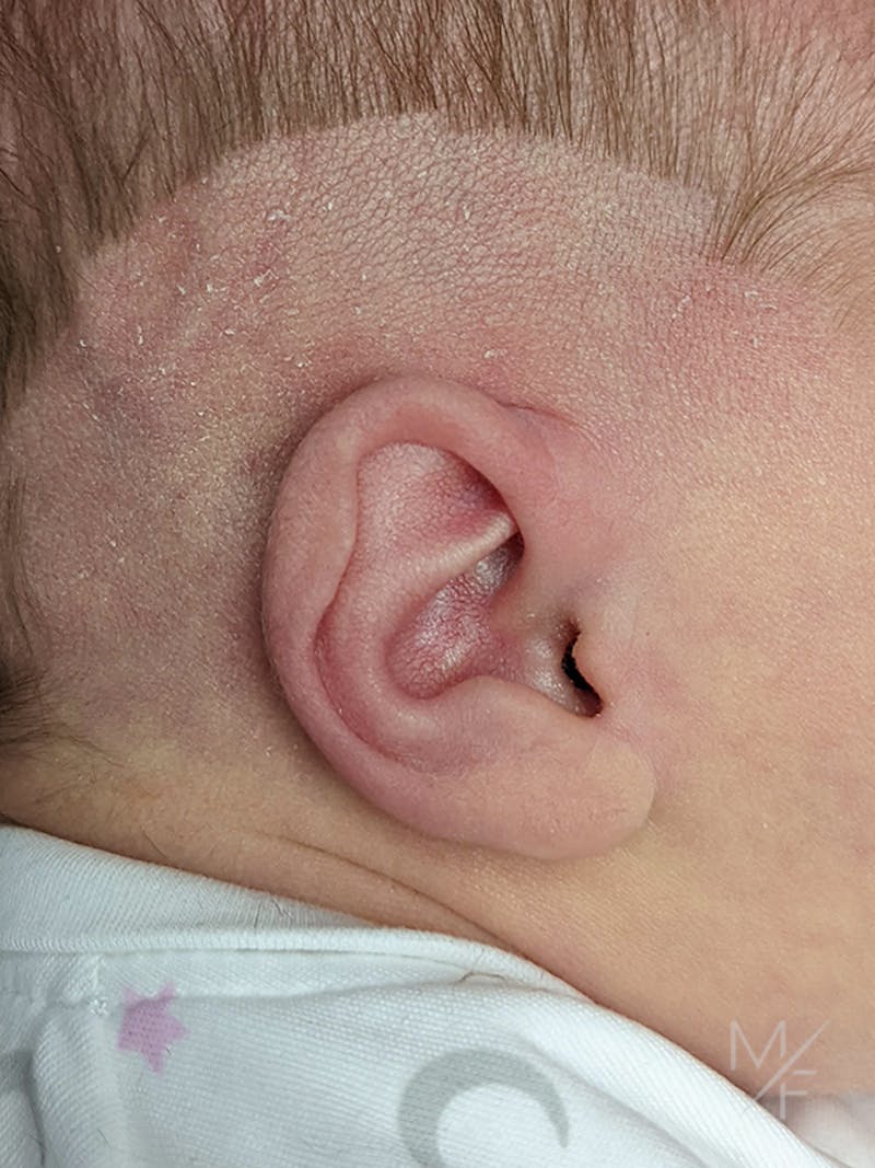 Ear Molding Before & After Gallery - Patient 121139469 - Image 3