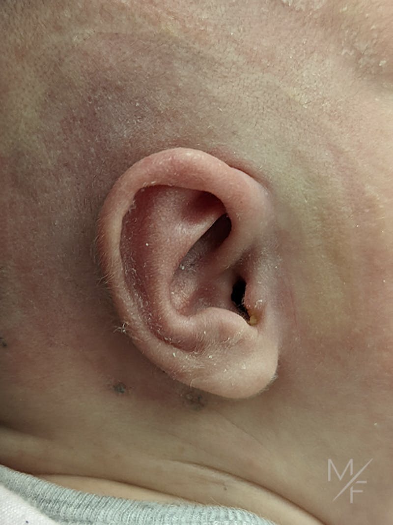 Ear Molding Before & After Gallery - Patient 121139469 - Image 4