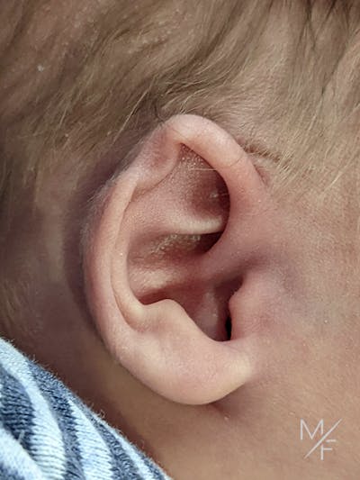 Ear Molding Before & After Gallery - Patient 121139470 - Image 1