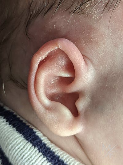 Ear Molding Before & After Gallery - Patient 121139470 - Image 2