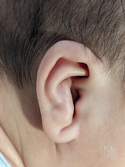Ear Molding Before & After Gallery - Patient 121139471 - Image 1