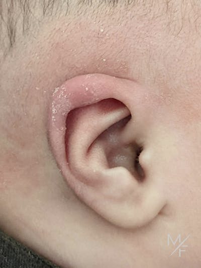 Ear Molding Before & After Gallery - Patient 121139471 - Image 2