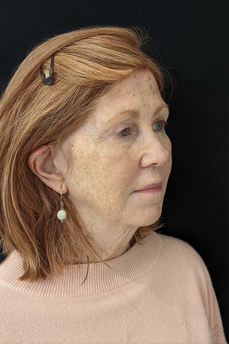 Neck Lift Before & After Gallery - Patient 367901 - Image 3