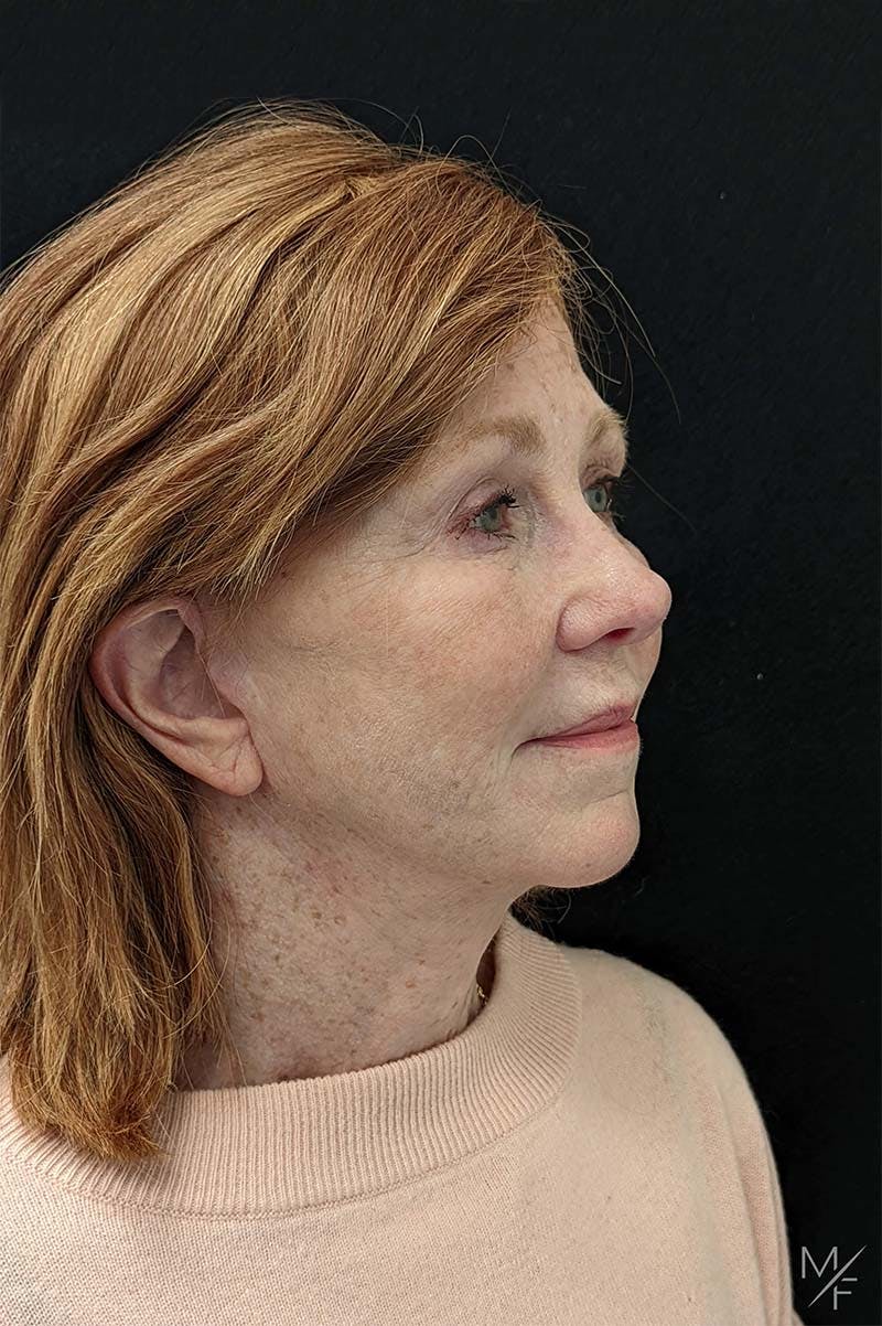 Neck Lift Before & After Gallery - Patient 367901 - Image 4